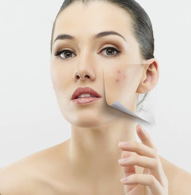 Mulher com acne em parte do rosto Mulher com acne em parte do rosto