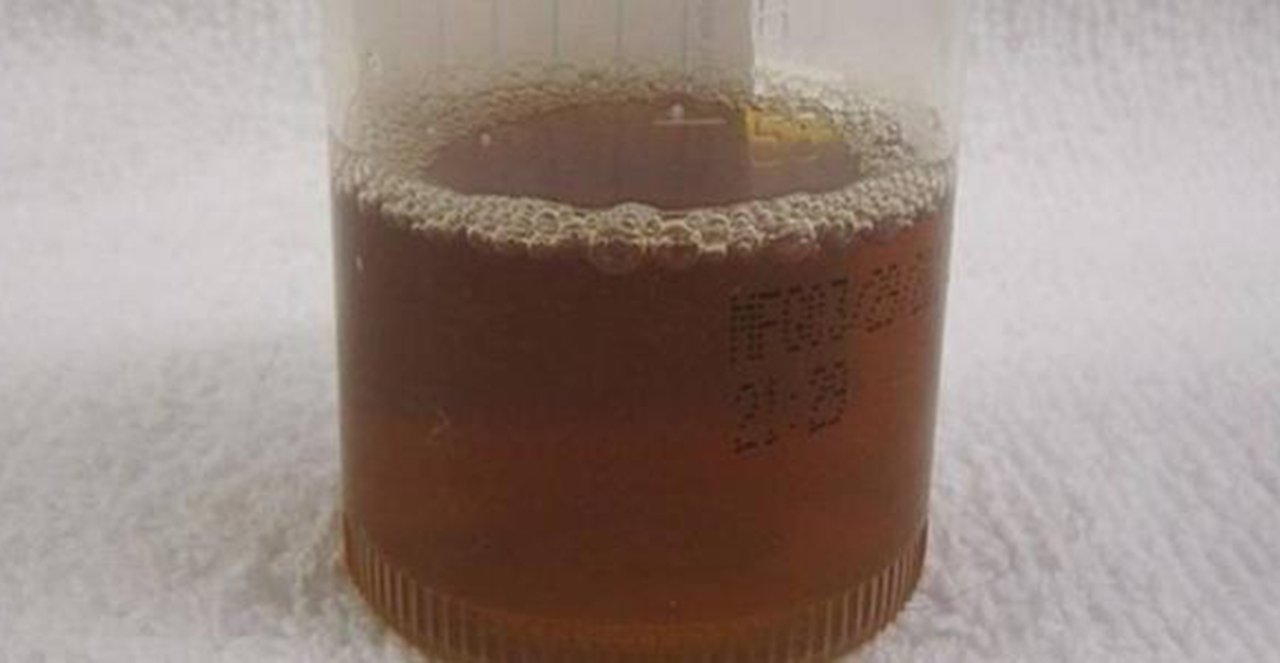 Imagem de um exame de urina alterado apresentando uma coloração mais escura