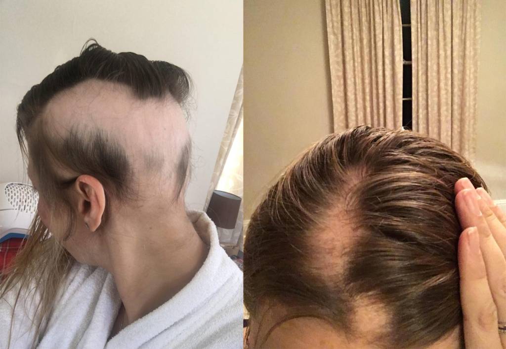 mulher-cabelo-queda mulher-cabelo-queda