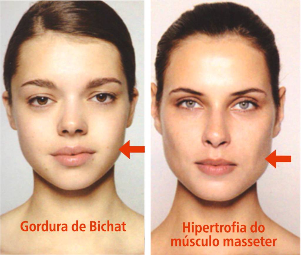 bichectomia-2 bichectomia-2
