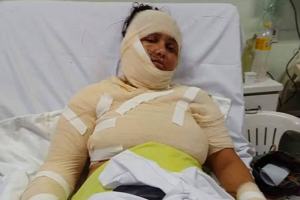Mulher tem 70% do corpo queimado com óleo quente jogado pelo marido
