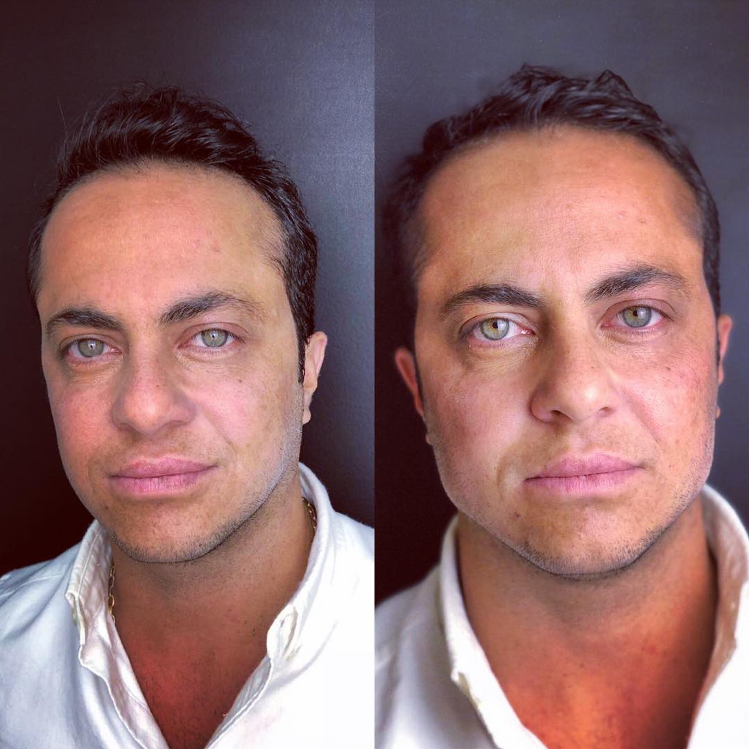 Antes e depois: veja os famosos que fizeram harmonização facial