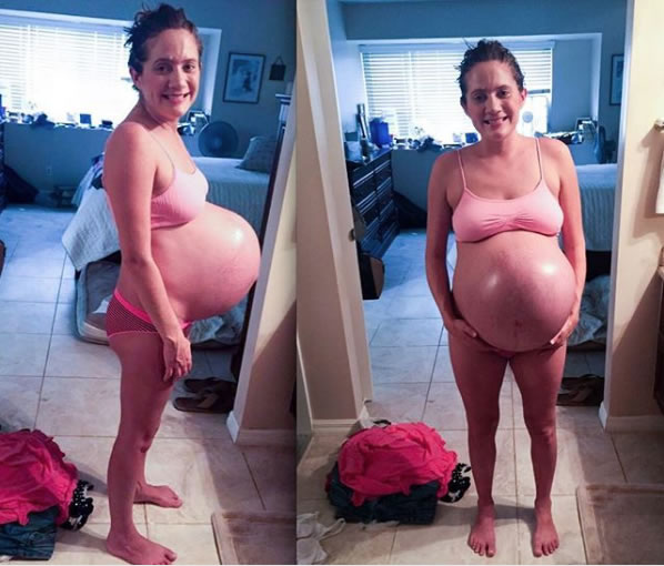 Mulher grávida de trigêmeos