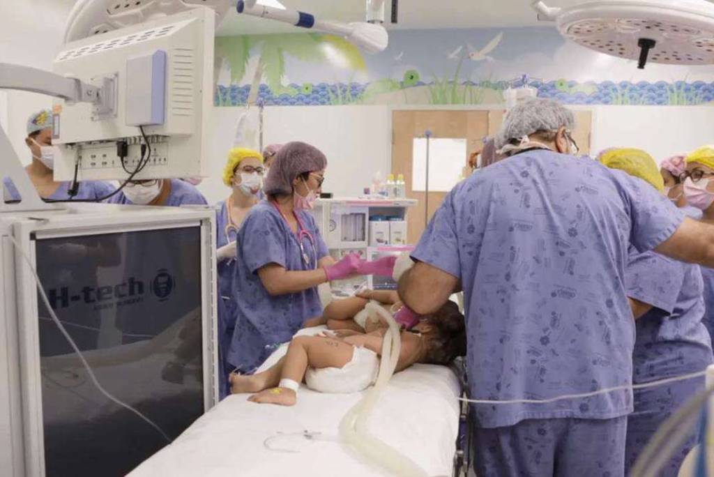 gemeas siamesas 2 Cirurgia de separação de gêmeas siamesas