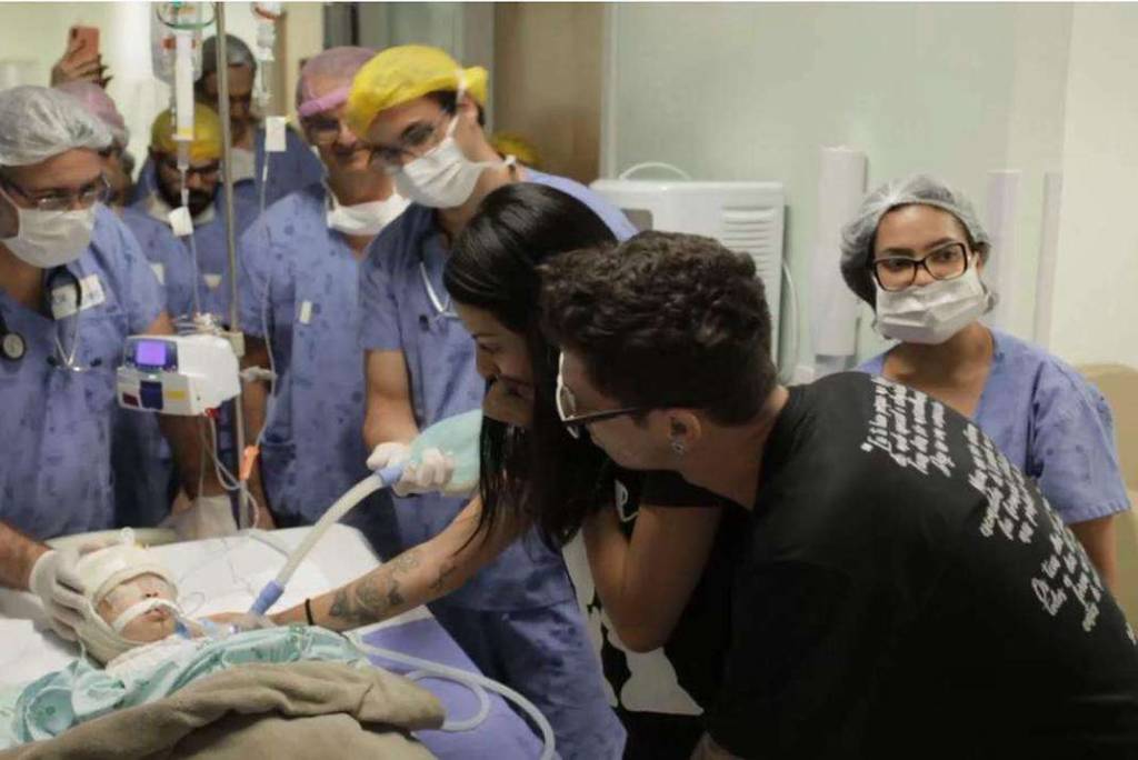 gemeas siamesas 3 Pós operatório de cirurgia de separação de gêmeas siamesas