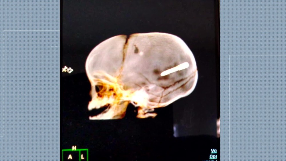 A radiografia mostra prego alojado no crânio da criança