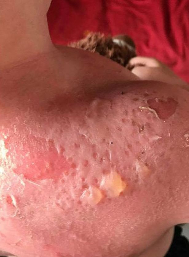 Pele do menino após sofrer as queimaduras