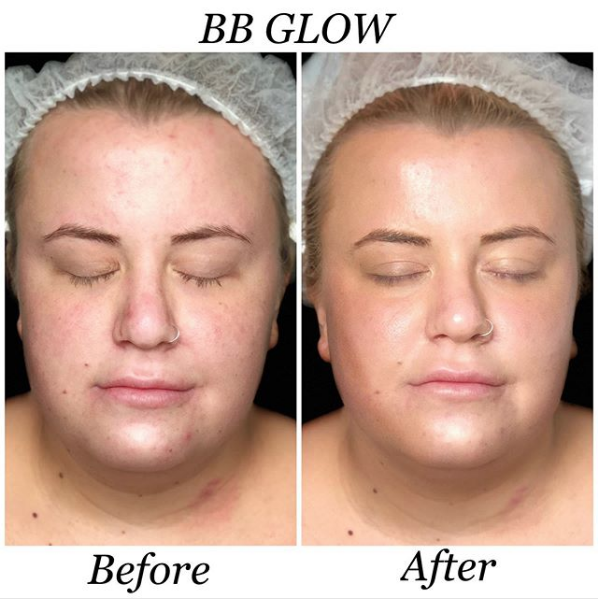 Novo tratamento de beleza: BB Glow
