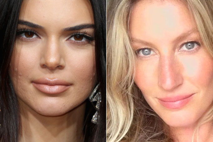 12 famosas que têm ou tiveram acne e já contaram como cuidam da pele