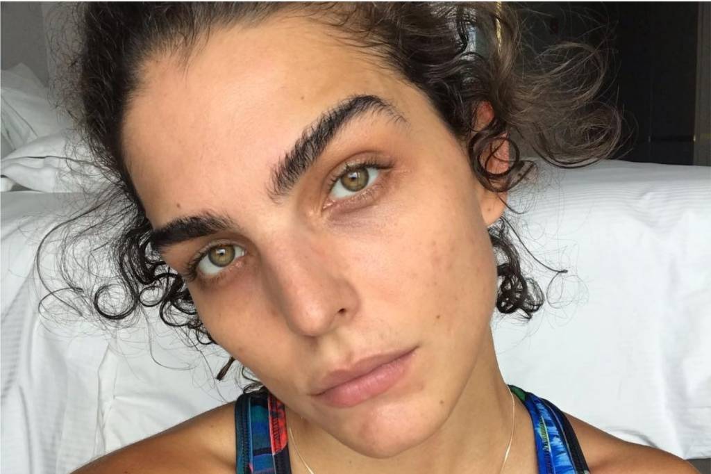 Julia Konrad fala sobre aceitação da acne após parar com anticoncepcional