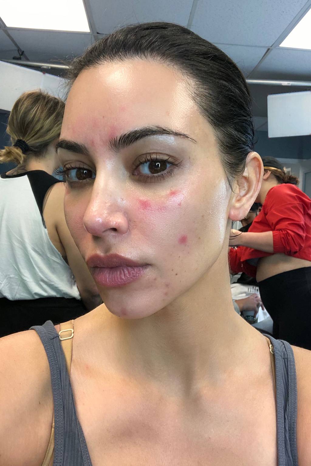 kim kardashian psoriase kim-kardashian-psoriase-