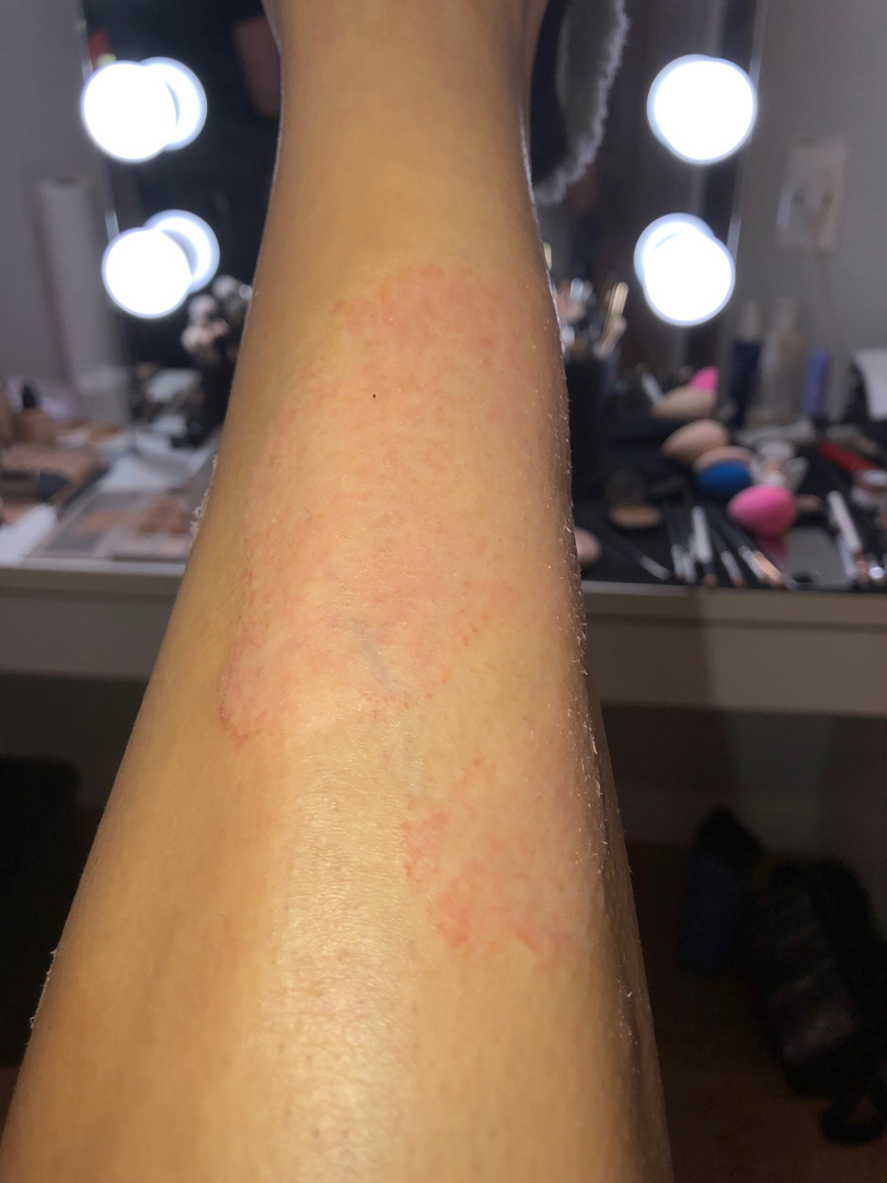 kim kardashian psoriase kim-kardashian-psoriase-2