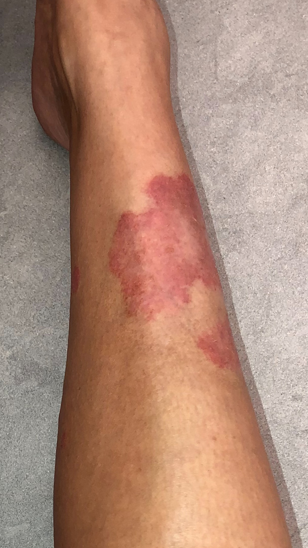 kim kardashian psoriase kim-kardashian-psoriase-3