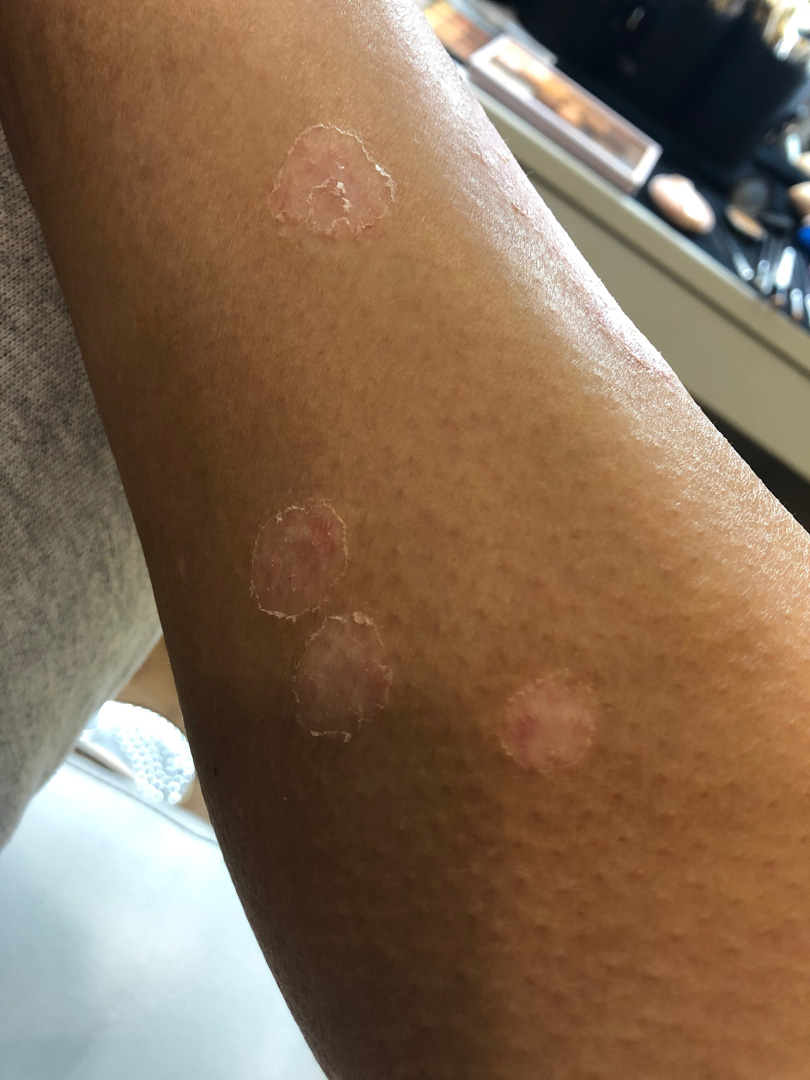 kim kardashian psoriase kim-kardashian-psoriase-4