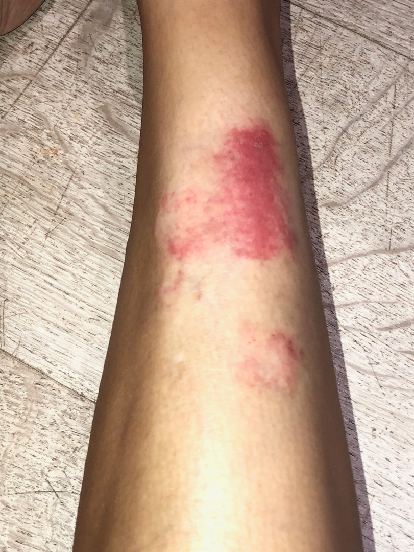 kim kardashian psoriase kim-kardashian-psoriase-5