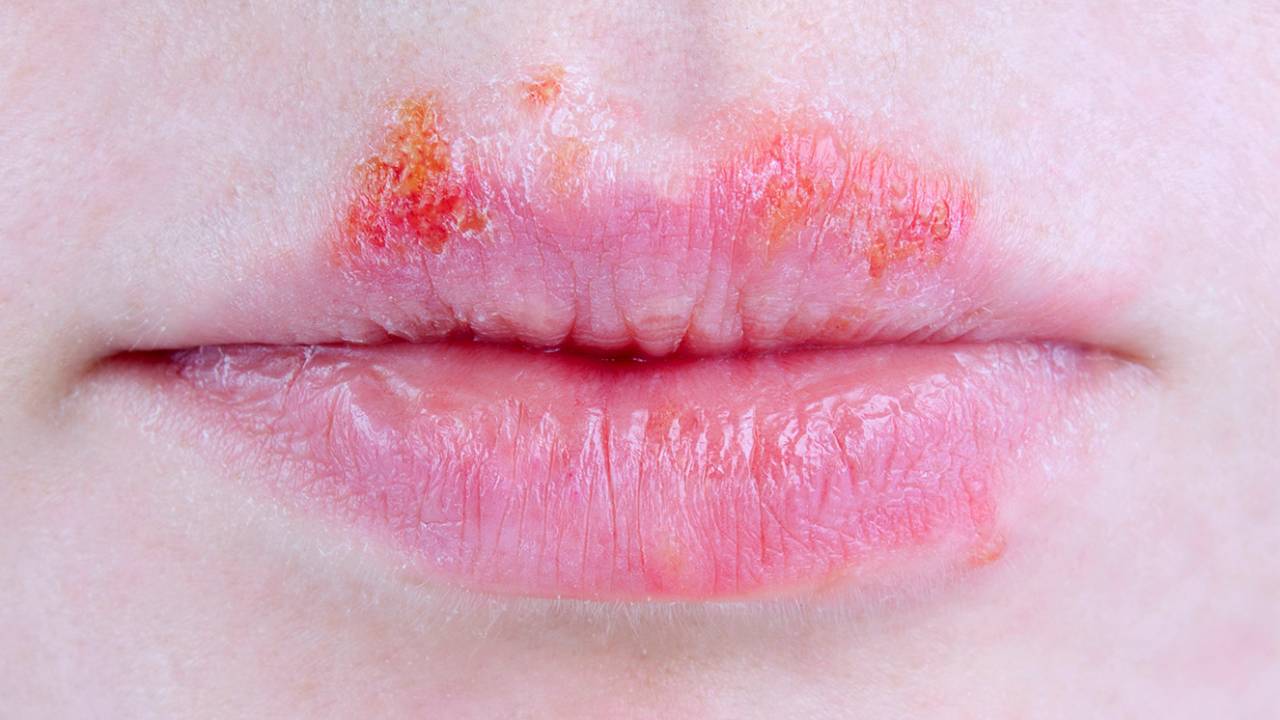 herpes