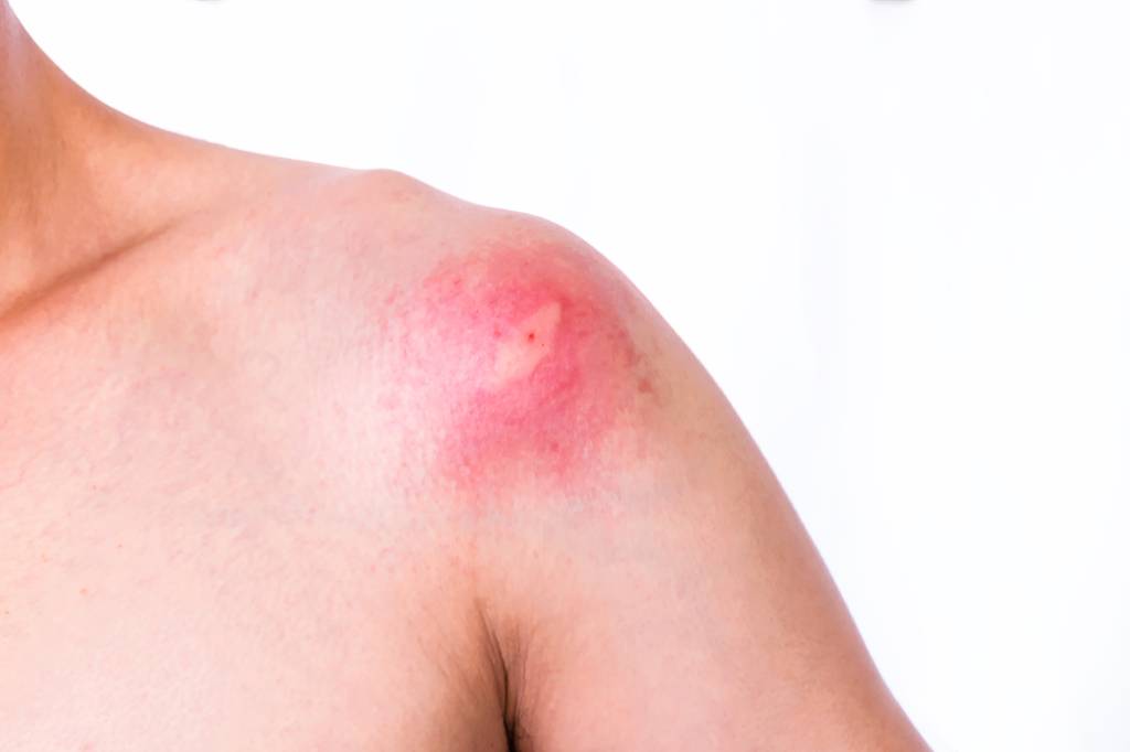 bee, wasps, Insect Bite sting on the skin