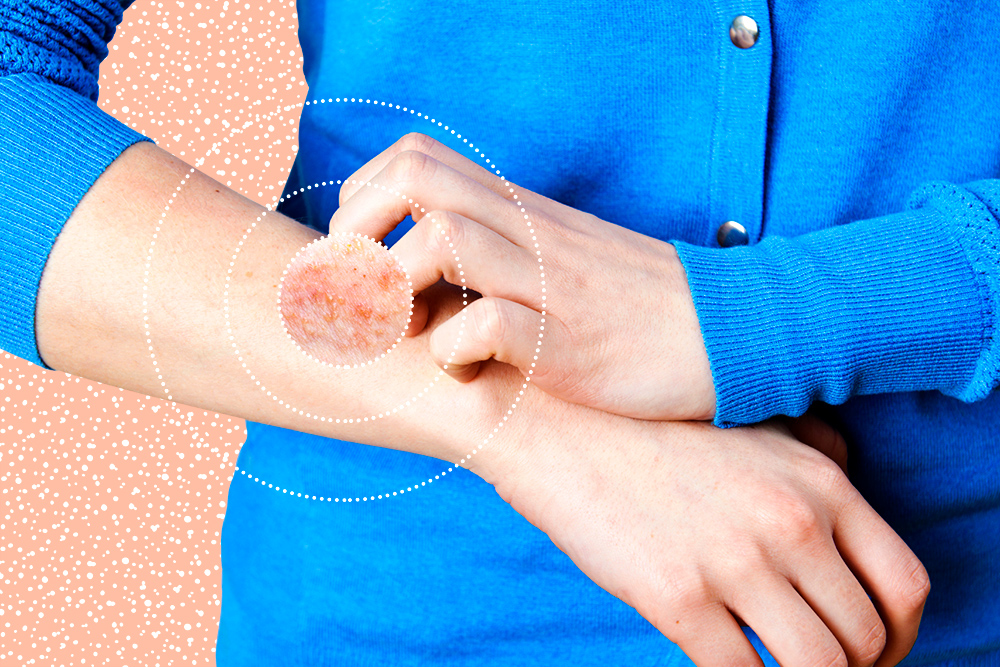 Psoríase: tudo o que você precisa saber sobre a doença
