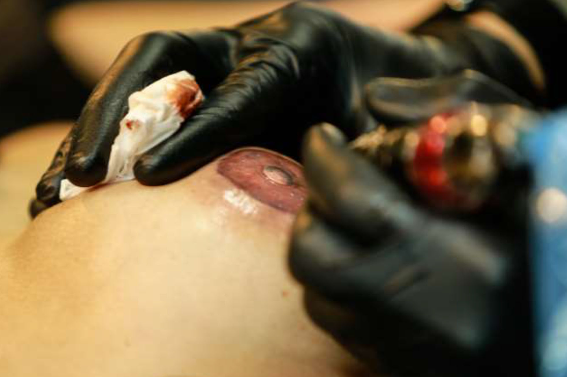Reconstrução de aréola por tatuagem