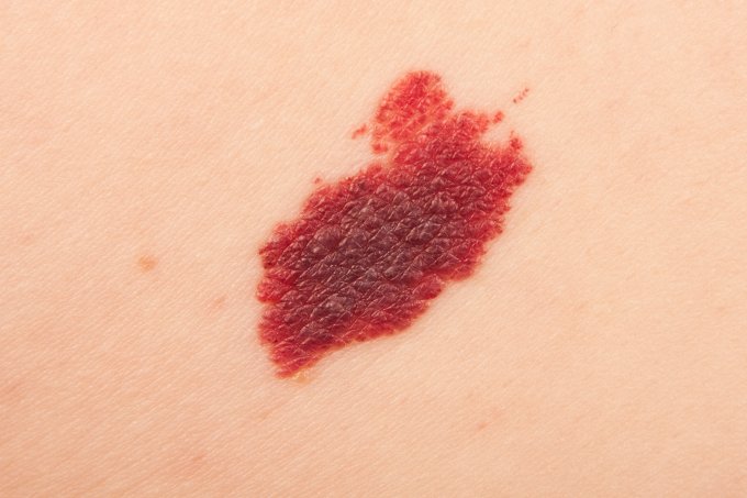 Tipos de manchas de pele – câncer de pele