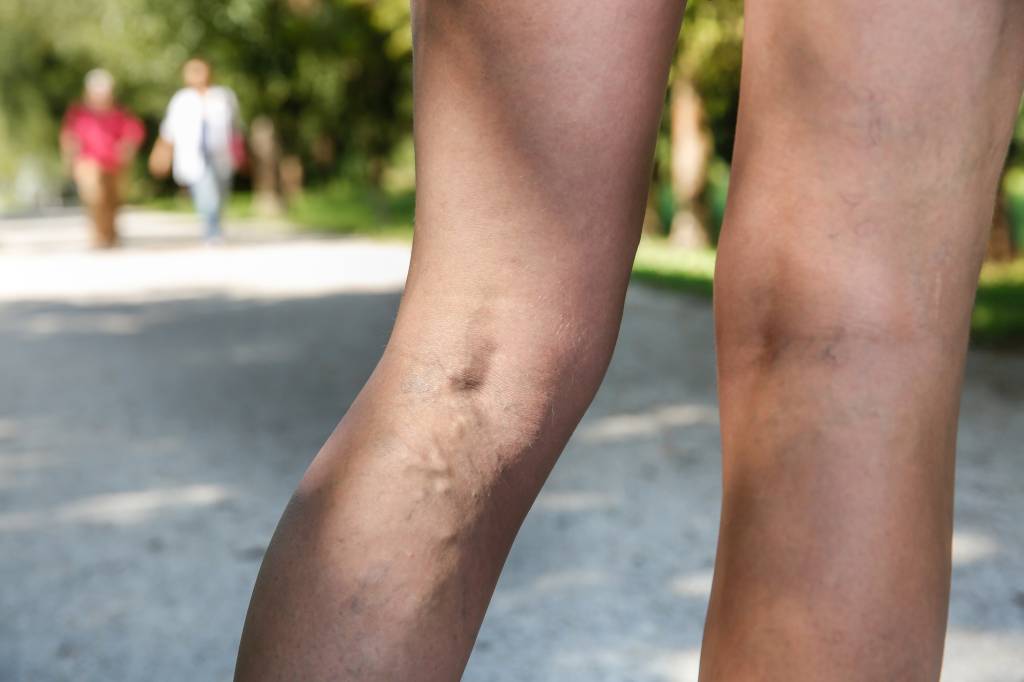 Painful varicose and spider veins on womans legs
