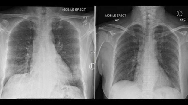 Raios-x dos pulmões de pacientes diagnosticada com a Covid-19