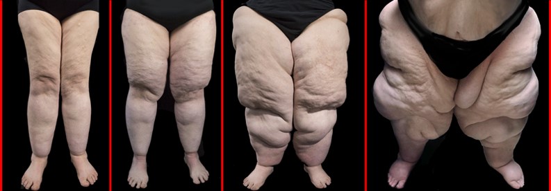 os quatro estágios do lipedema