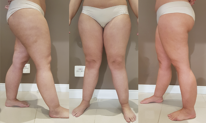 lipedema