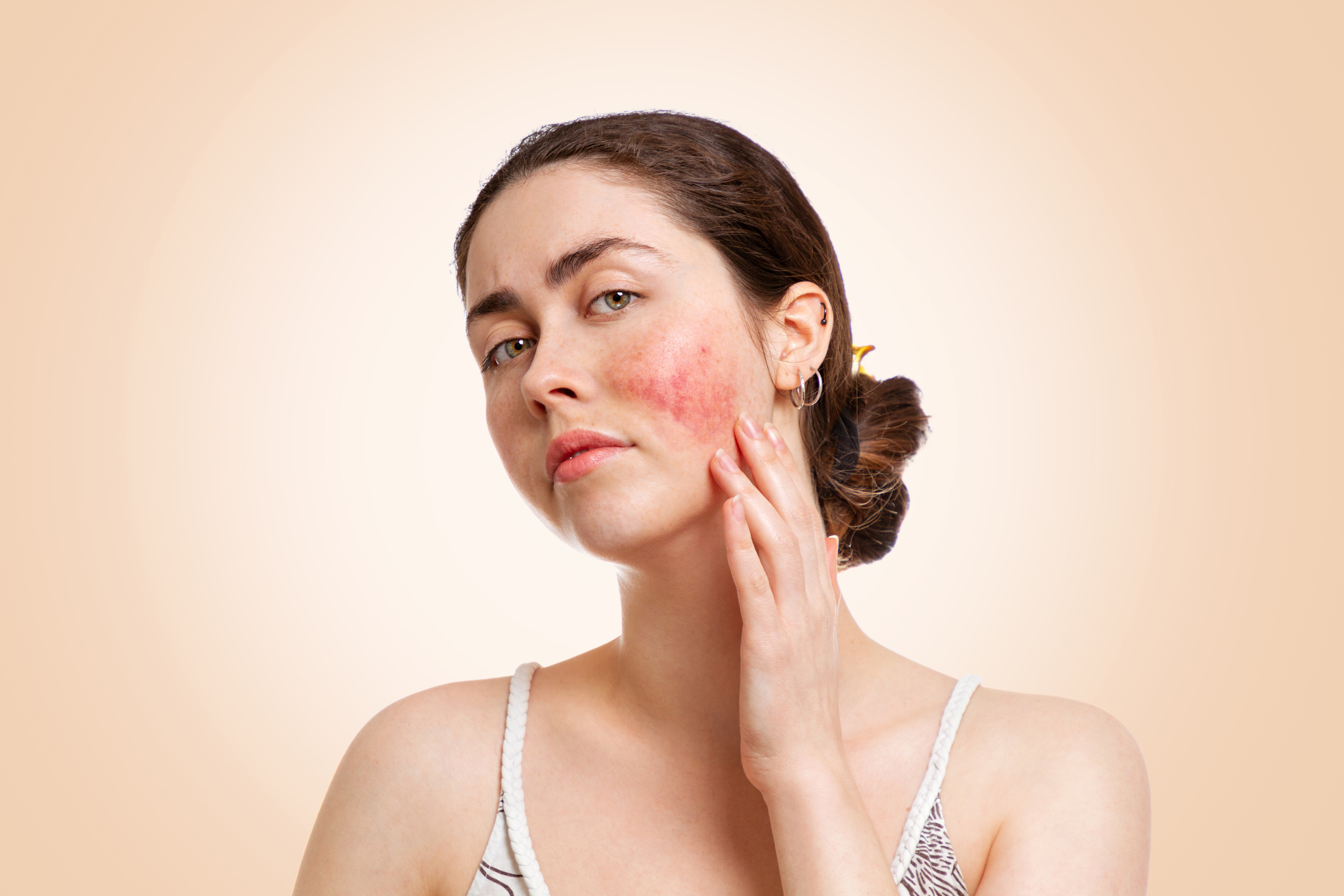 Rosácea: doença inflamatória de pele pode ser tratada com laser
