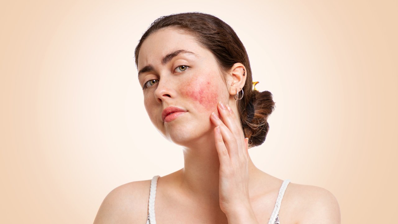 Rosácea: doença inflamatória de pele pode ser tratada com laser