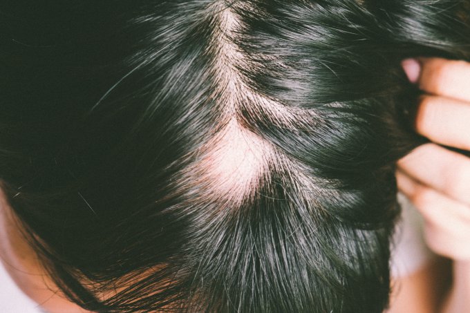 Man with alopecia areata on head, Spot Baldness, Hair fall problem