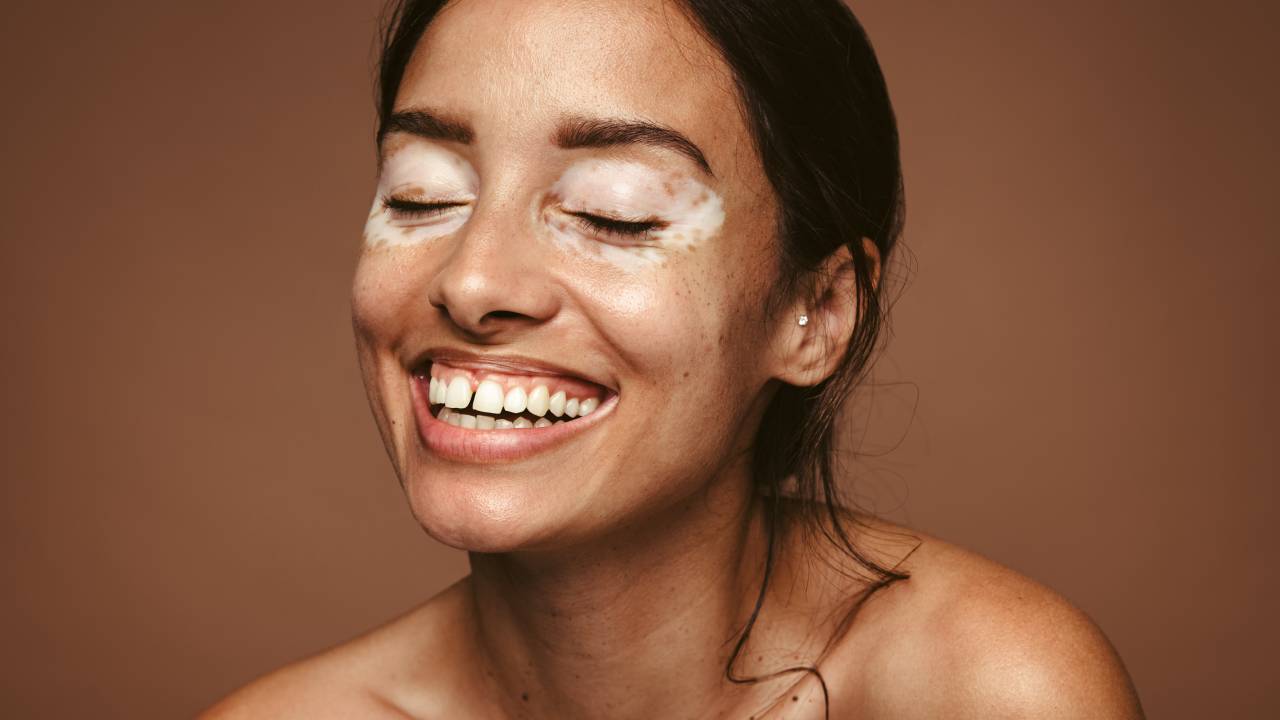 skincare com vitiligo