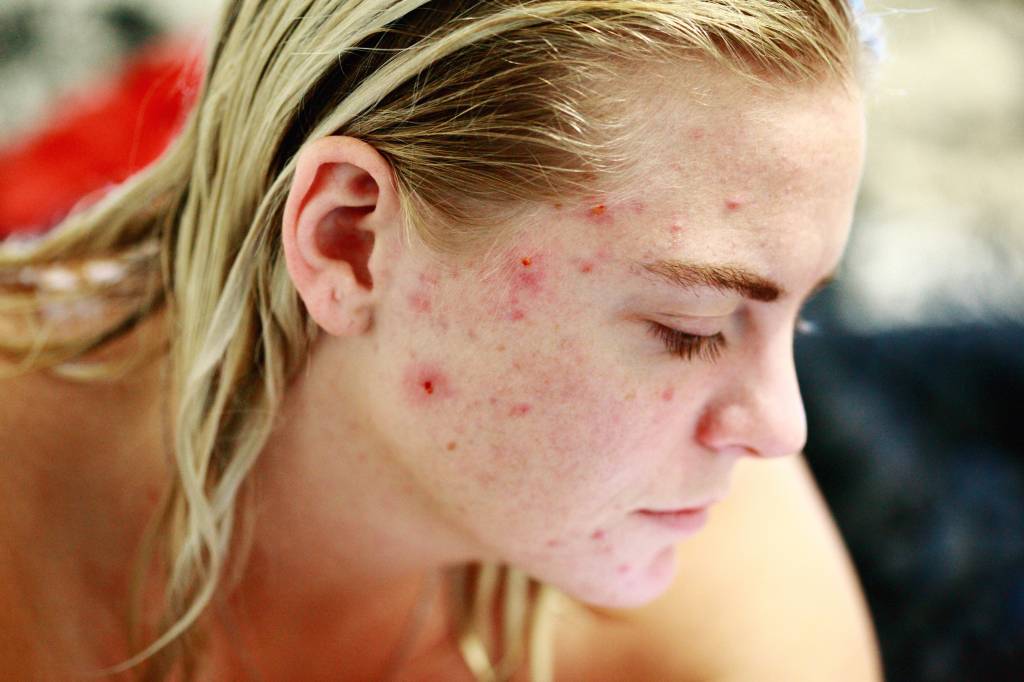 acne acne