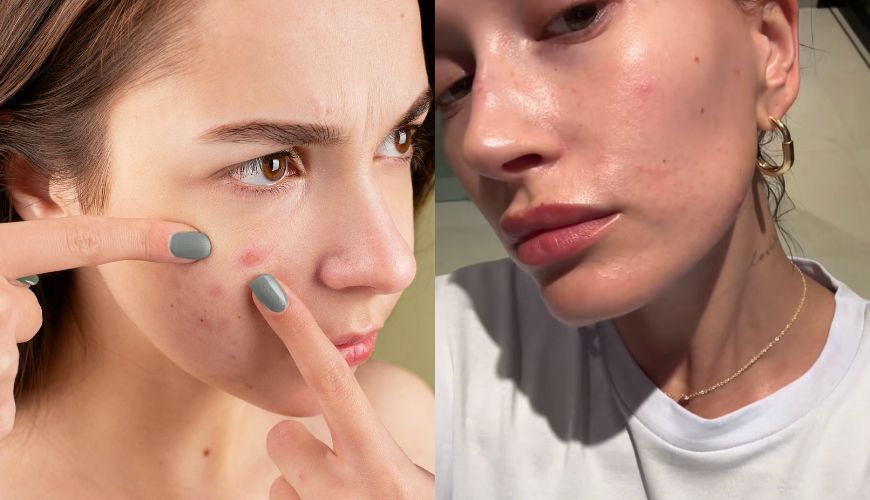 Dermatite Perioral: Entenda o diagnóstico de Hailey Bieber