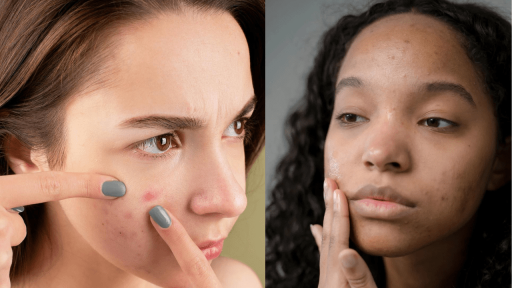 O açúcar é um dos grandes responsáveis pela inflamação da pele
