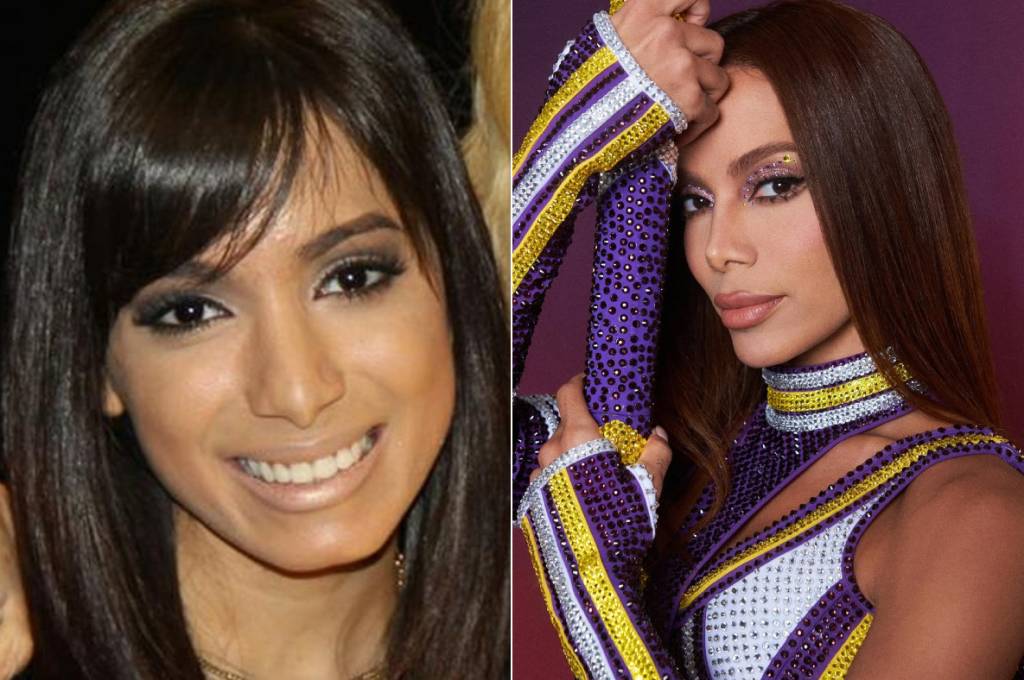 Anitta antes da rinoplastia e atualmente