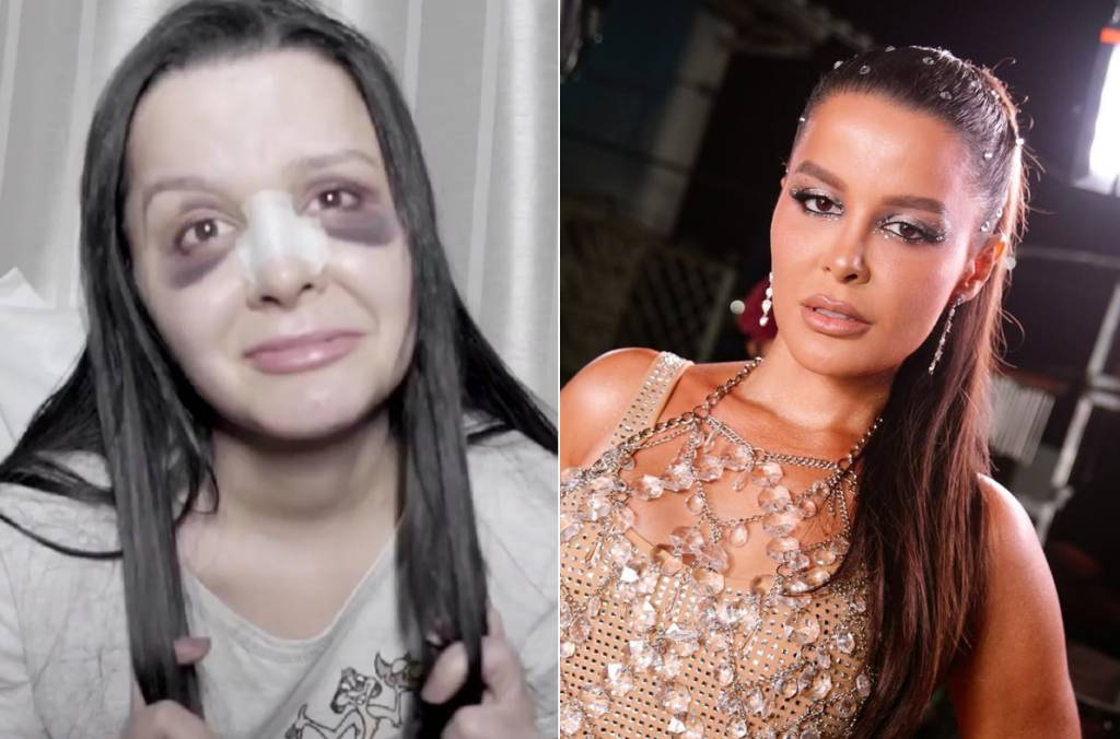 A cantora Maraísa mostrou os curativos no nariz após a cirurgia, há 5 anos