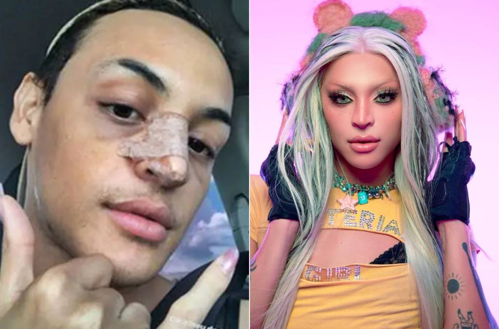 Pabllo Vittar mostrou como estava seu nariz logo após a rinoplastia