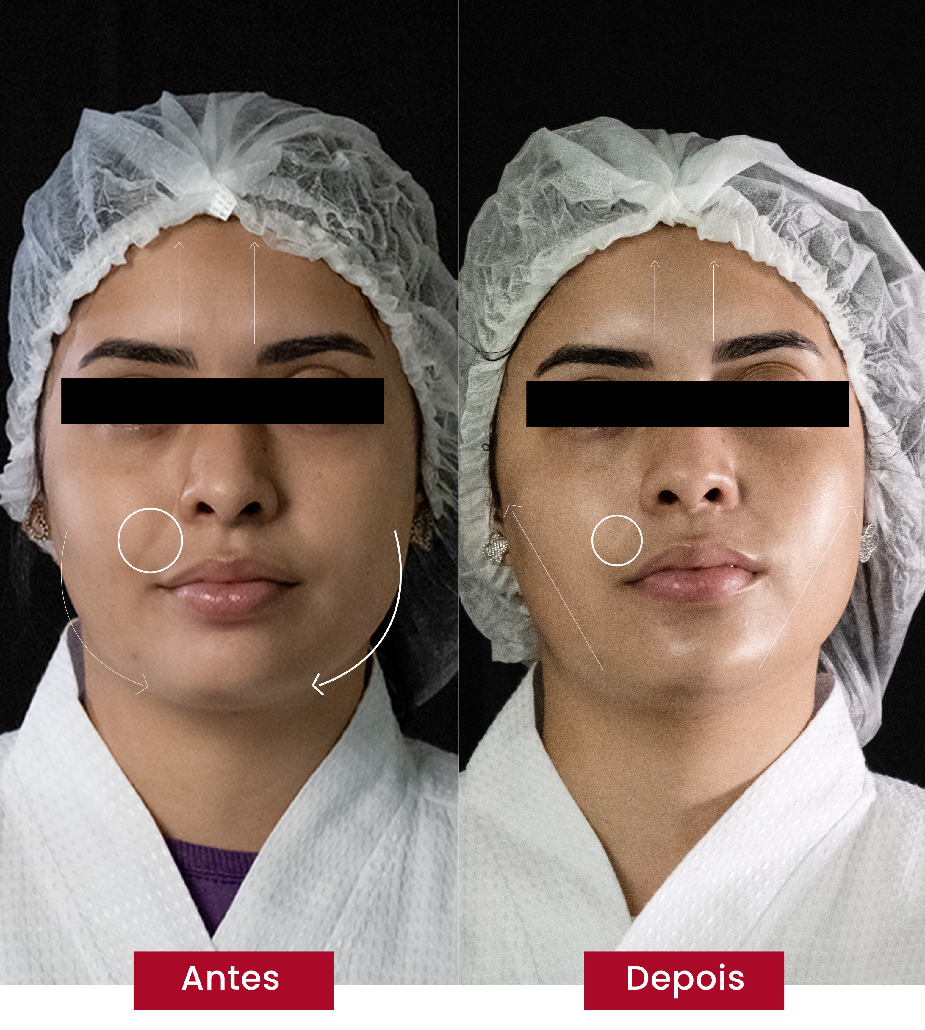 Em três sessões, é possível ver diferenças no rosto de quem faz a glass skin coreana
