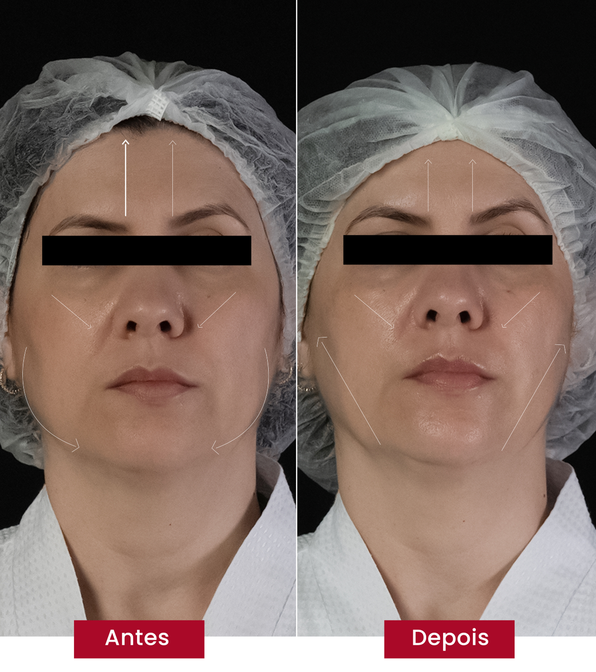 Marcas de expressão também são suavizadas com glass skin coreana