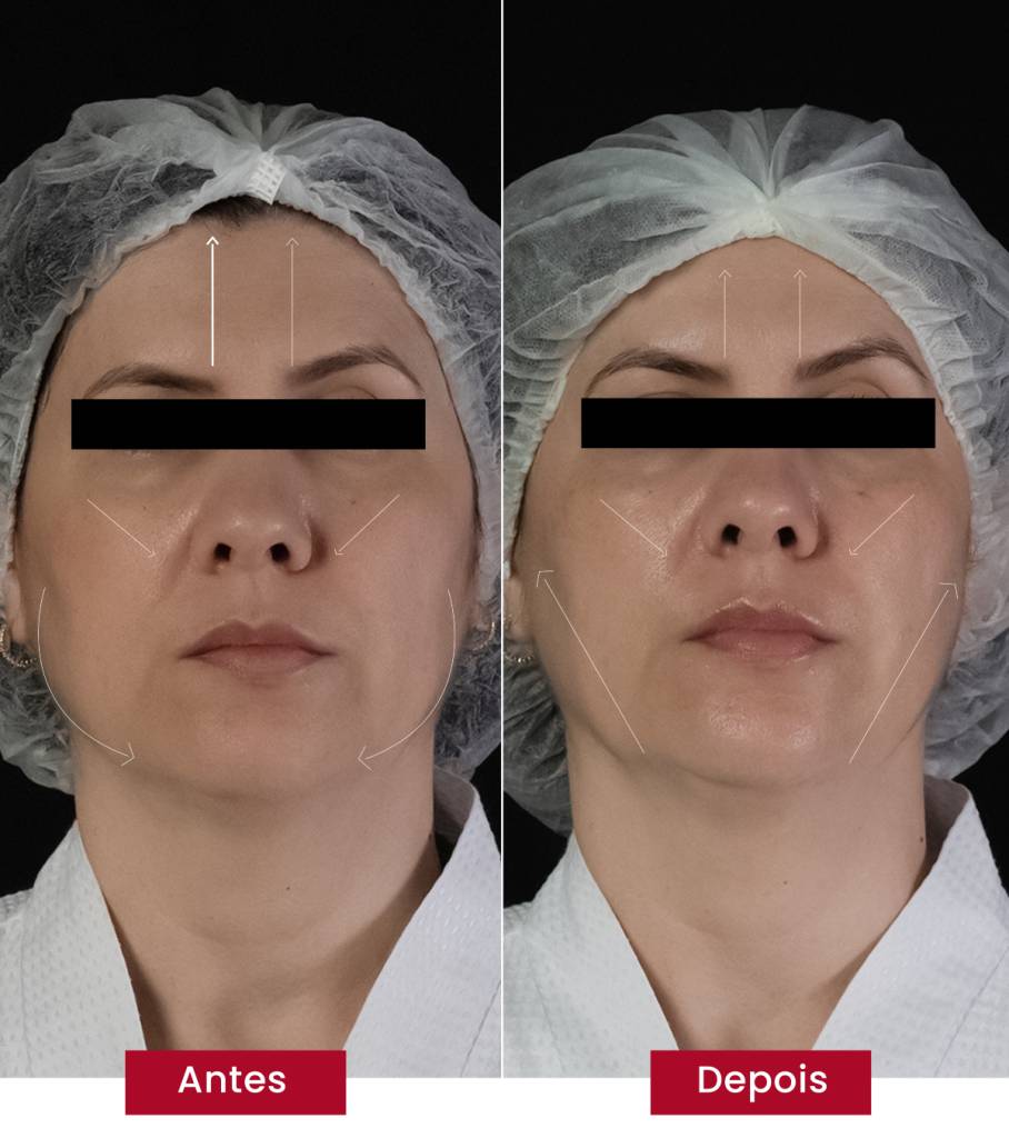 Marcas de expressão também são suavizadas com glass skin coreana