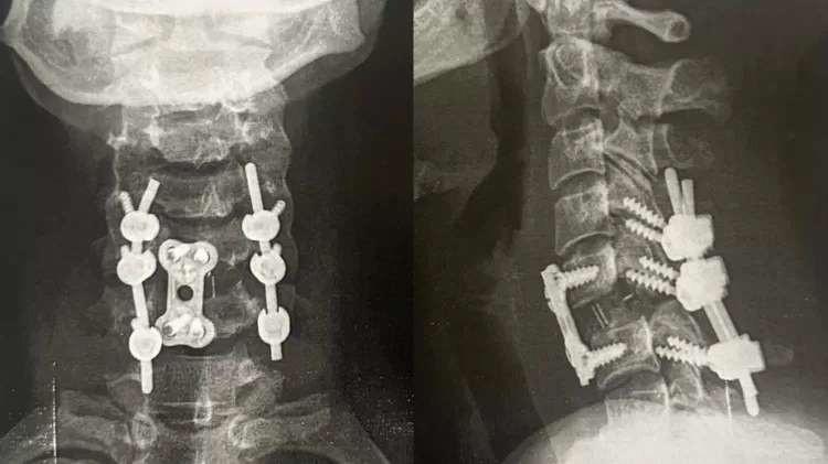 Lindalva precisou fazer uma cirurgia para colocar as vértebras c5 e c6 no lugar certo