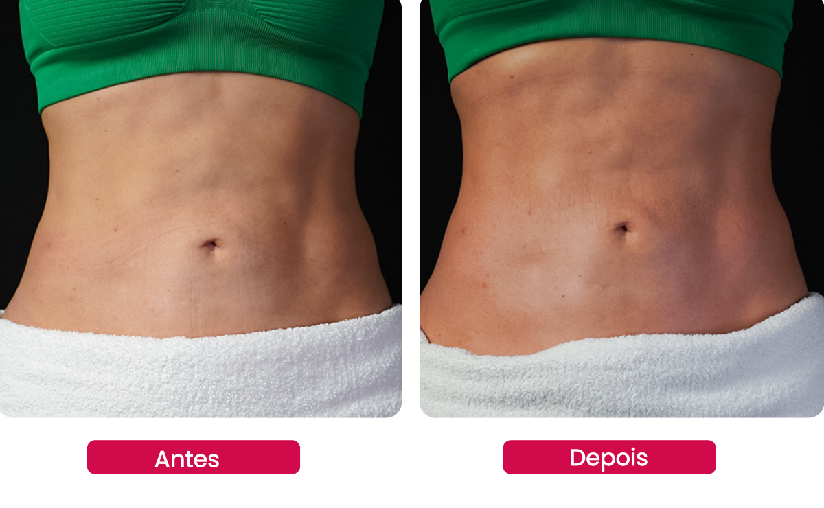 Micro-agulhamento biológico busca reduzir os efeitos que a perda de peso de forma abrupta causa na pele do corpo inteiro, como derretimento facial, bumbum caído, flacidez nas pernas e flacidez muscular