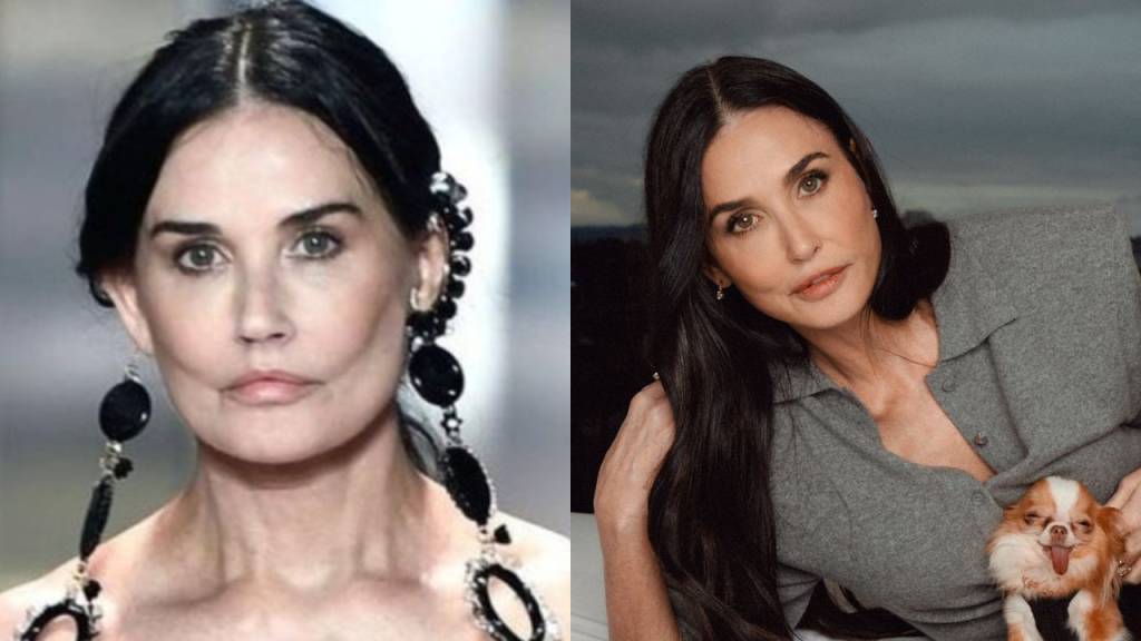substancias-lifting Imagem antes e depois de mulher de pele madura após fazer procedimento estético.