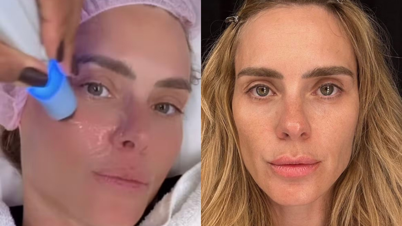 Montagem de duas fotos: à esquerda, uma mulher loira de touca rosa e rosto com gel transparente recebe tratamento facial com aparelho azul luminoso; à direita, a mesma mulher, com cabelos soltos e sem maquiagem, olha diretamente para frente